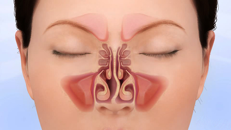 Cấu trúc bên trong của mũi có vách ngăn bị lệch.