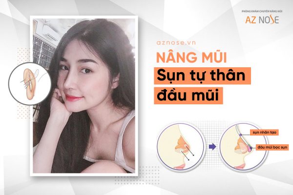 7 Lời khuyên của bác sĩ về nâng mũi bọc sụn tự thân đầu mũi