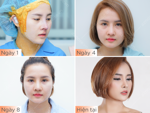Nâng mũi bao lâu thì lành? Mũi sau nâng không thể đẹp trong ngày một ngày hai Sự thay đổi của dáng mũi theo thời gian