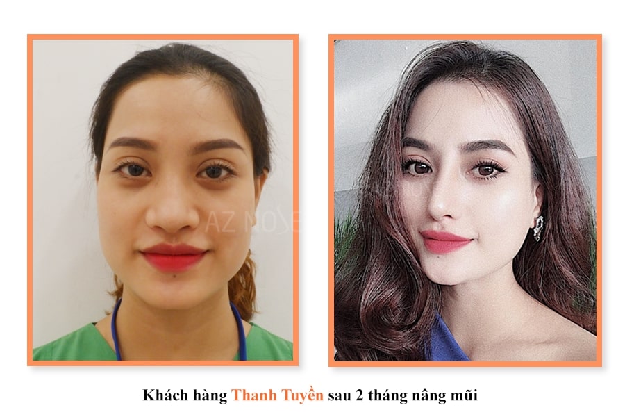 Khách hàng Thanh Tuyền sau 2 tháng nâng mũi Khách hàng Thanh Tuyền sau 2 tháng nâng mũi
