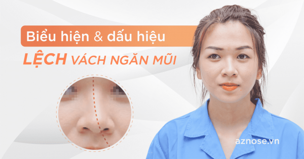 Dấu hiệu, triệu chứng của người bị lệch vách ngăn mũi