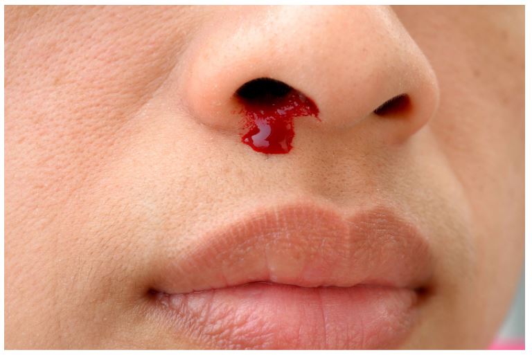 Thường xuyên chảy máu mũi là biến chứng nghiêm trọng khi bị lệch vách ngăn mũi