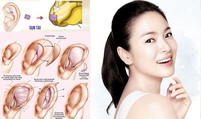 Nâng mũi sử dụng sụn tai Nâng mũi sử dụng sụn tai