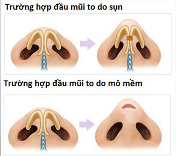 Có thể nâng mũi cùng với thu nhỏ đầu mũi được không ?