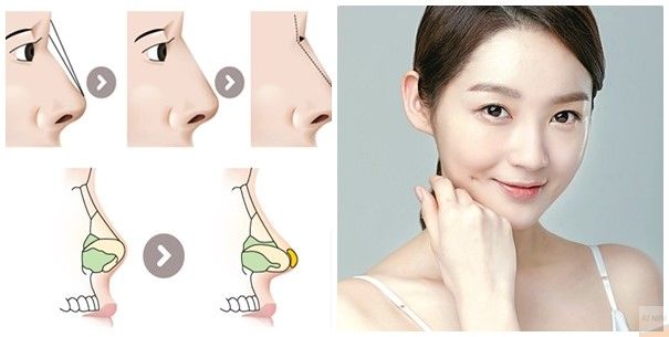 Phương pháp nâng mũi sụn tự thân Phương pháp nâng mũi sụn tự thân