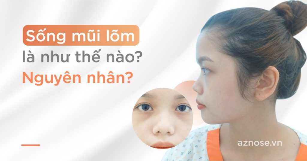 Sống mũi lõm là như thế nào? Nguyên nhân của tình trạng sống mũi lõm?