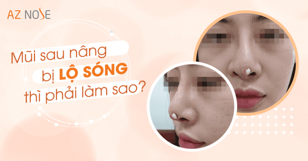 Mũi sau nâng bị lộ sóng thì phải làm sao ?