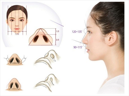 Cắt cánh mũi là phương pháp tiểu phẩu vô cùng đơn giản