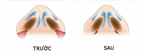 Hình ảnh phương pháp cuộn cánh mũi