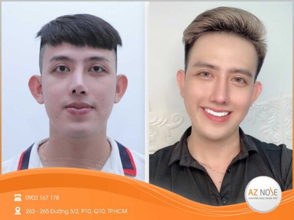 "Giải Cứu" Dáng Mũi Lệch - Tìm Lại Vẻ Tự Tin