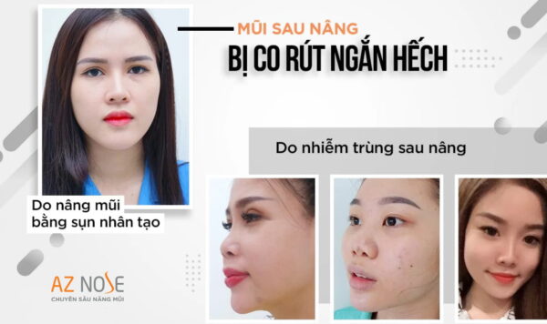 Sửa mũi ngắn hếch sau khi nâng mũi thất bại với phương pháp nào ?