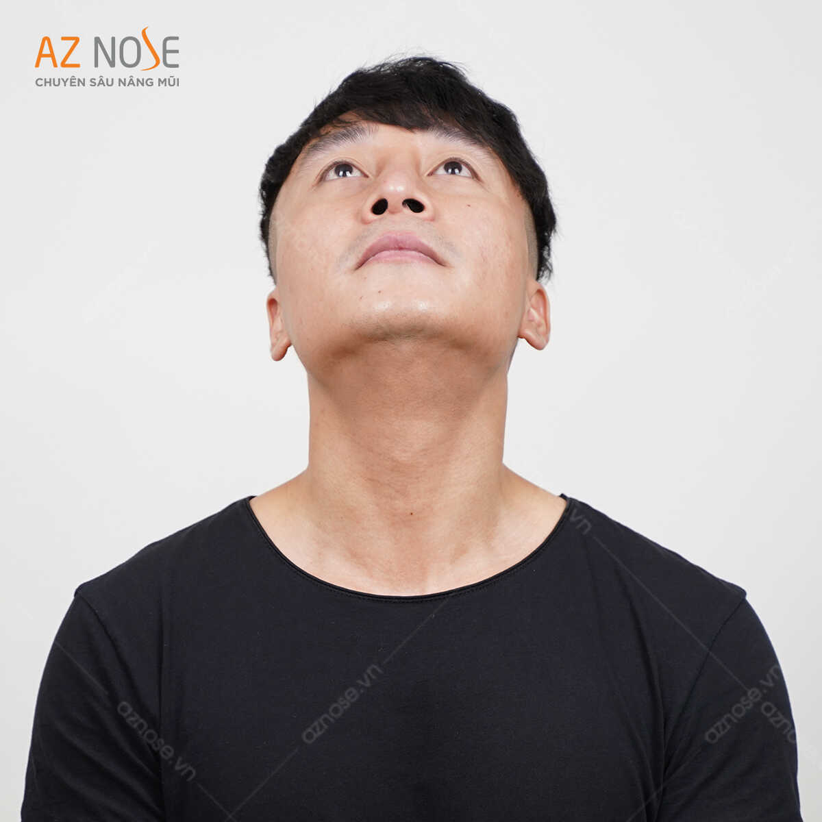 Tình trạng mũi trước khi nâng: Đầu mũi lệch phải, lỗ mũi hai bên không đều