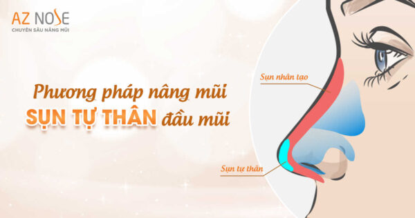 Phương pháp nâng mũi nhân tạo và bọc sụn tự thân đầu mũi
