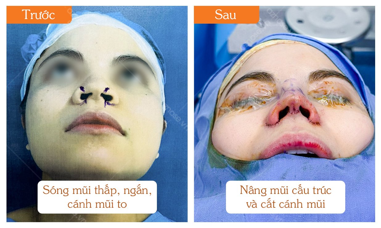 Tình trạng trước - sau ca phẫu thuật nâng mũi do Bác sĩ CKI. Nguyễn Hoàng Nam và Bác sĩ CKI. Đinh Xuân Sơn Tùng trực tiếp thực hiện