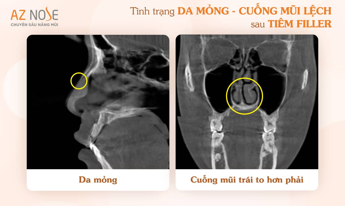 Hình chụp CT 3D của khách hàng M.T. cho thấy tình trạng da mũi mỏng sau tiêm filler.