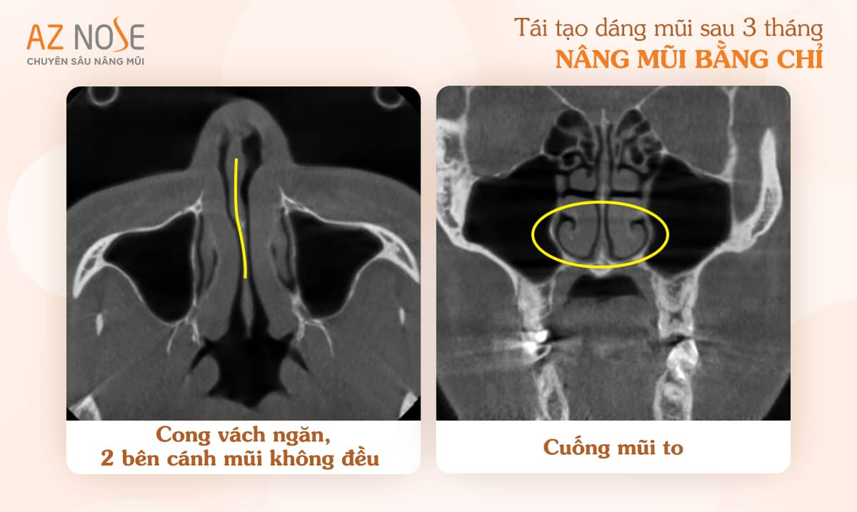 Hình ảnh chụp CT3D tình trạng mũi lệch vách ngăn do nâng mũi chỉ ảnh hưởng