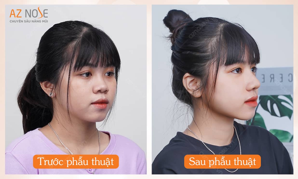 Tại sao sinh viên chọn nâng mũi để thay đổi bản thân?