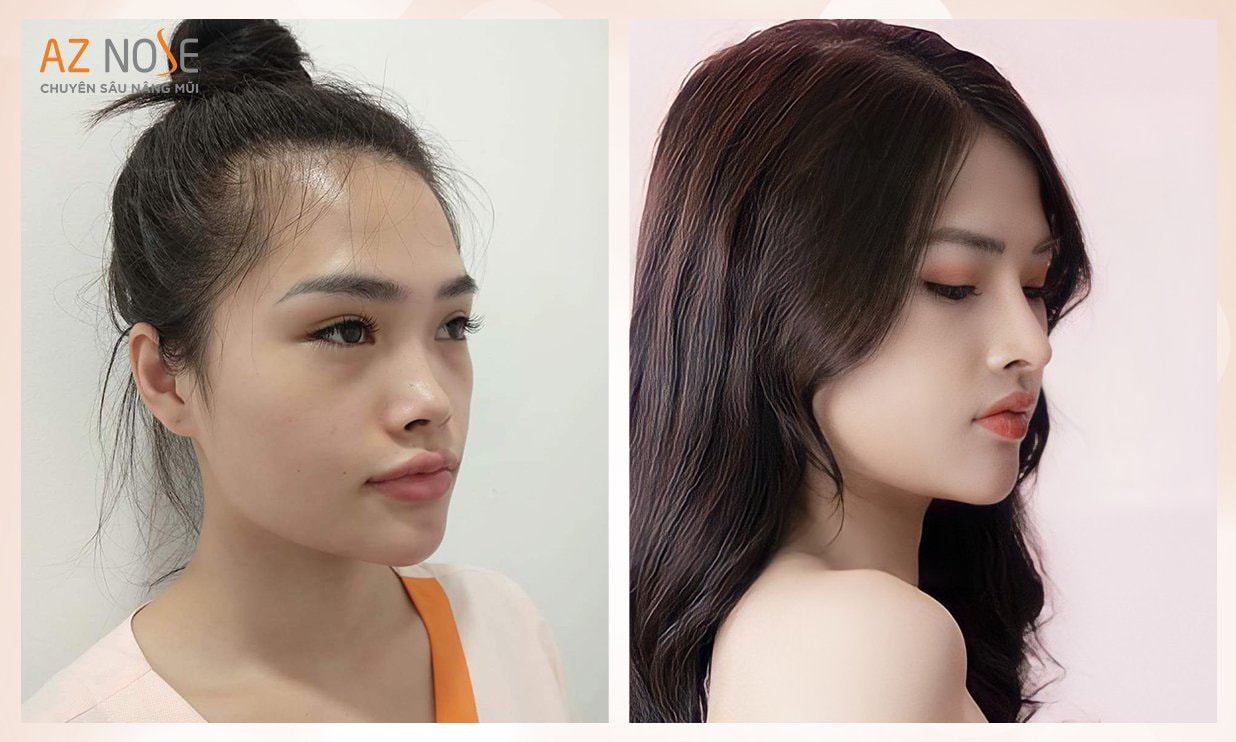 Chiếc mũi tẹt được khắc phục