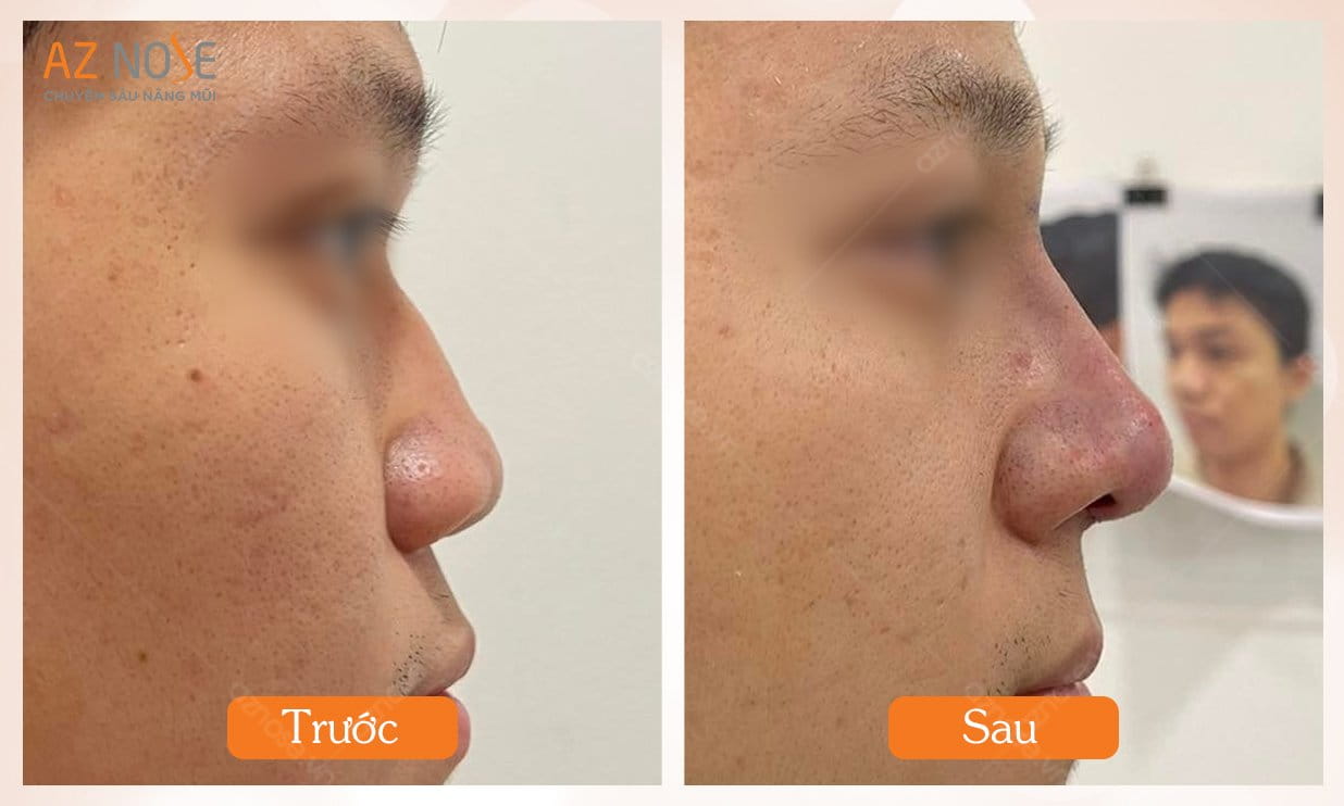 Dáng mũi trước - sau khi đục xương mũi gồ kết hợp nâng mũi cấu trúc tại AZ NOSE