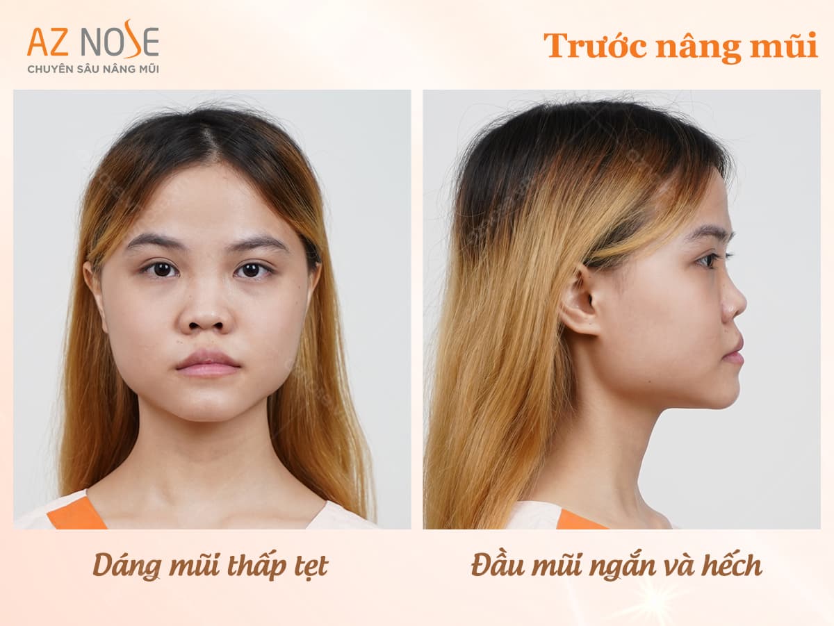 Dáng mũi thấp tẹt khiến đầu mũi ngắn và hếch