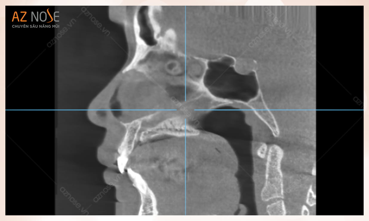 Hình ảnh CT 3D của khách hàng có da mũi nguyên thủy bị mỏng, cần bọc thêm Megaderm
