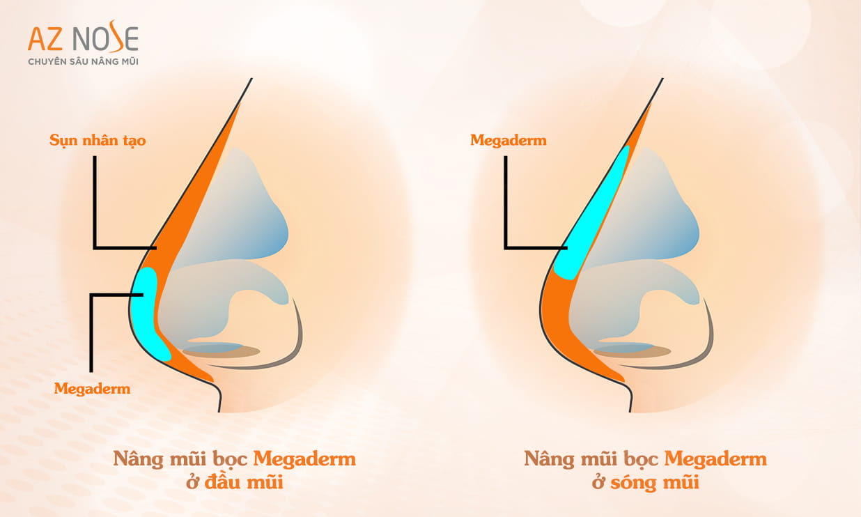 Nâng mũi với vật liệu Megaderm giúp hạn chế mỏng da