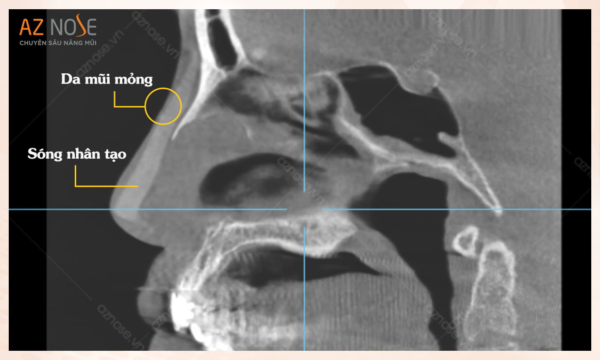 Hình ảnh CT 3D của khách hàng có da mũi mỏng sau khi sửa mũi hỏng, cần bọc Megaderm