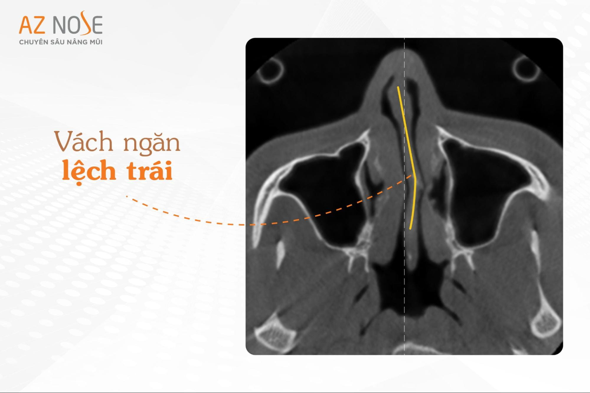 Vách ngăn lệch trái sâu của khách hàng Đ.T.T.O trên hình chụp CT 3D