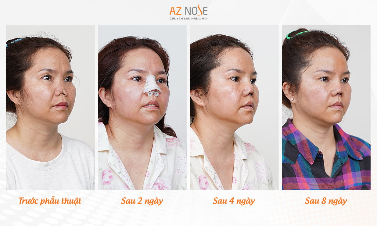 Hình ảnh trước và sau của khách hàng đến từ Canada khi tái tạo mũi hỏng với sụn Surgiform do nhiễm trùng, co rút trụ mũi 
