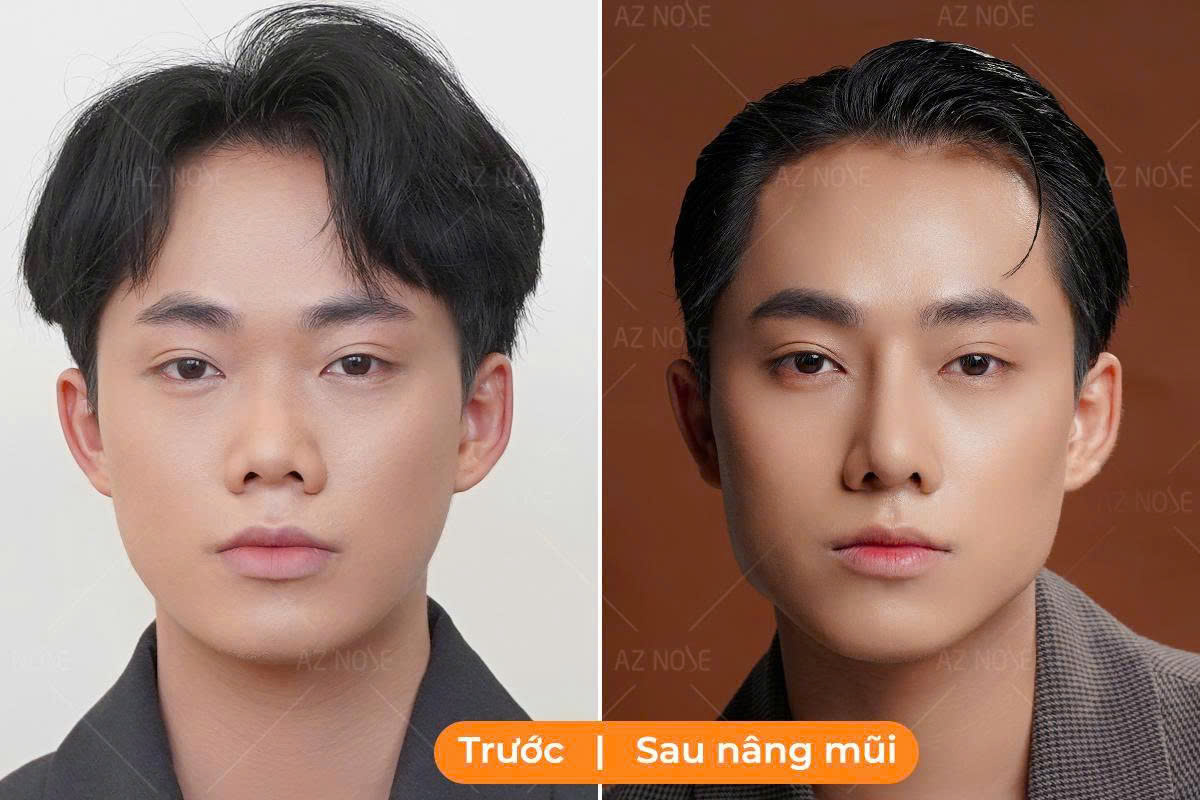 Thế nào là dáng mũi tự nhiên? Founder shop thời trang - N.T trước và sau 1 tháng nâng mũi cấu trúc tại phòng khám chuyên sâu nâng mũi AZ NOSE