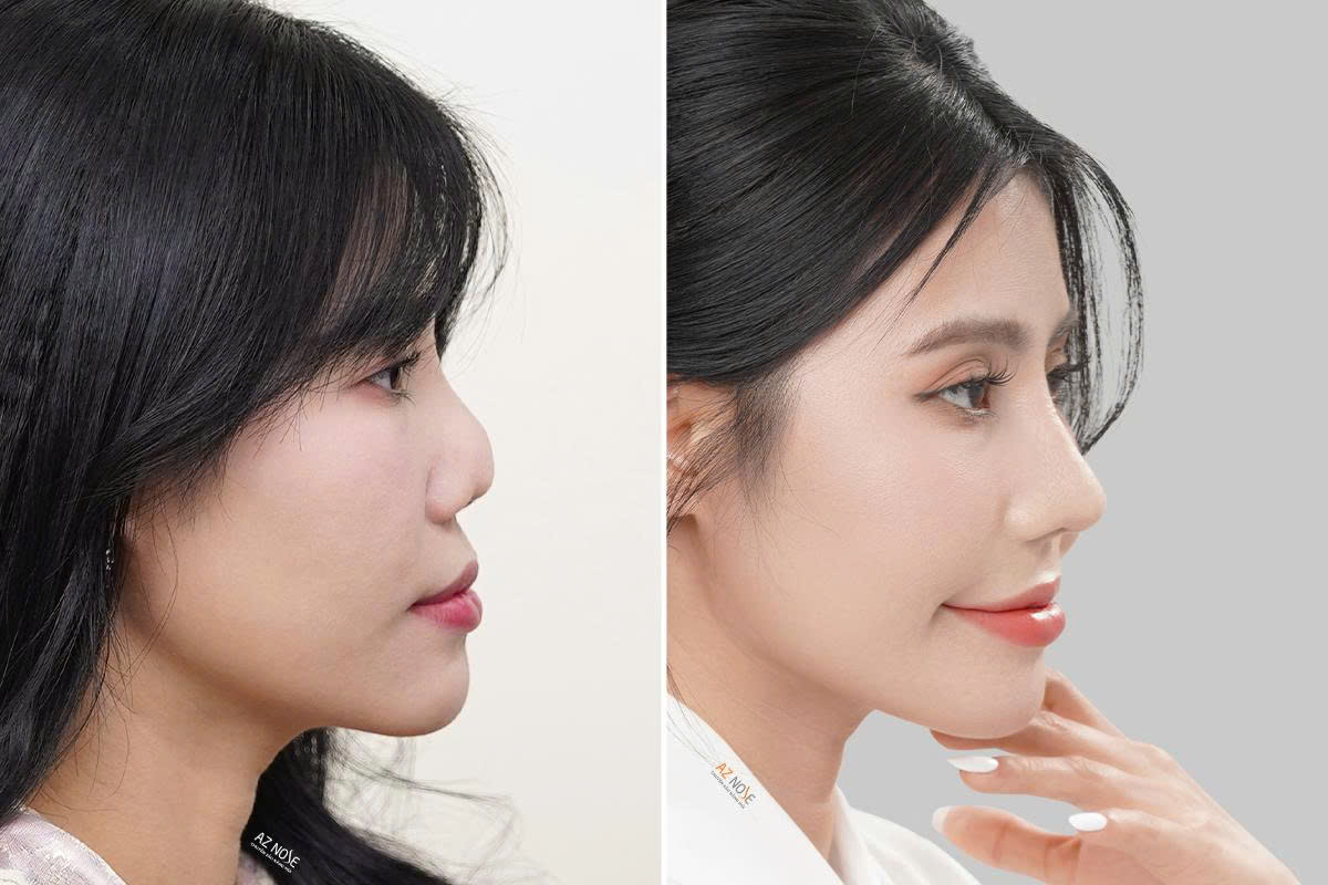 Chị A.H. trước và sau 3 tháng tái tạo mũi hỏng tại Phòng khám AZ NOSE 