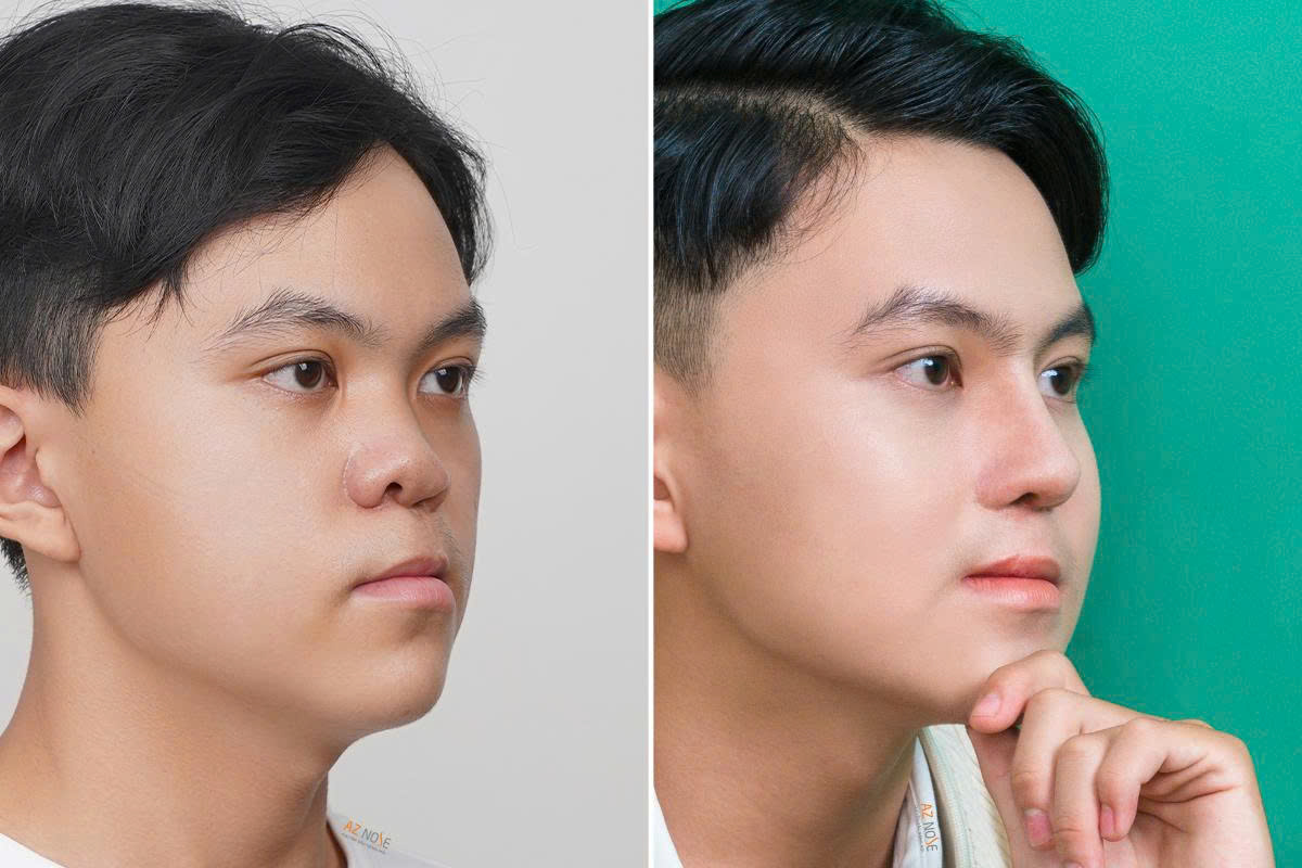 Anh H.H. trước và sau 2 năm nâng mũi tại Phòng khám thẩm mỹ AZ NOSE