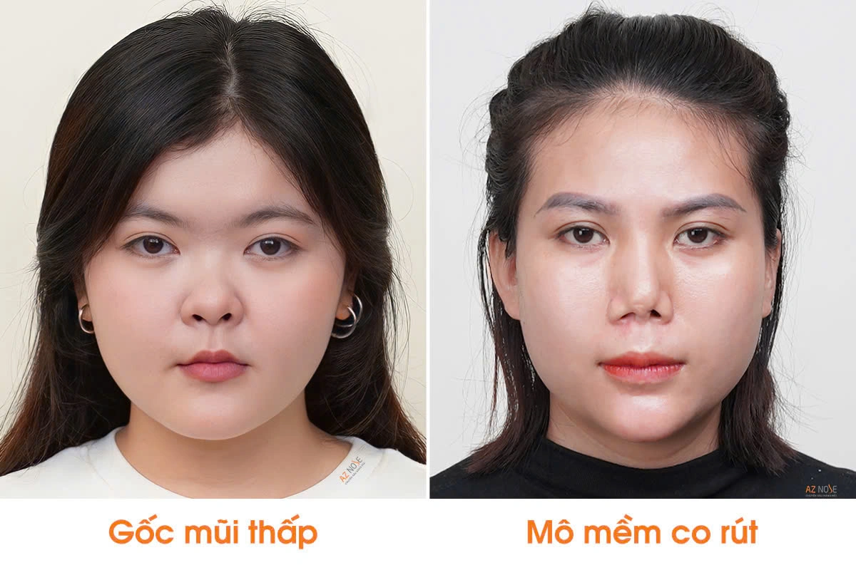 Chị T.A. (trái) và chị T.H. (phải) trước khi nâng mũi tại Phòng khám AZ NOSE