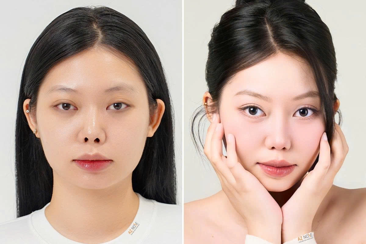 Chị T.L. trước và sau khi tái tạo mũi hỏng tại Phòng khám thẩm mỹ AZ NOSE