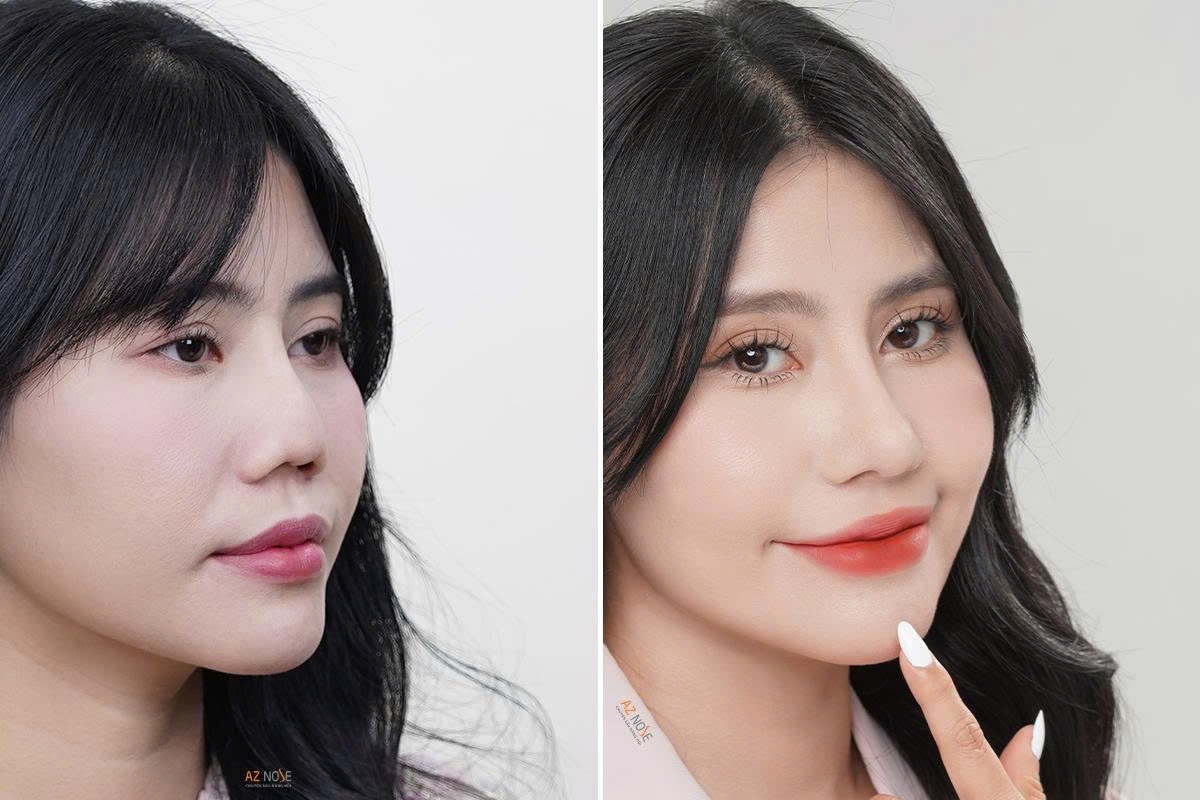 Chị Ánh Hương trước và sau 3 tháng tái tạo mũi hỏng tại Phòng khám AZ NOSE