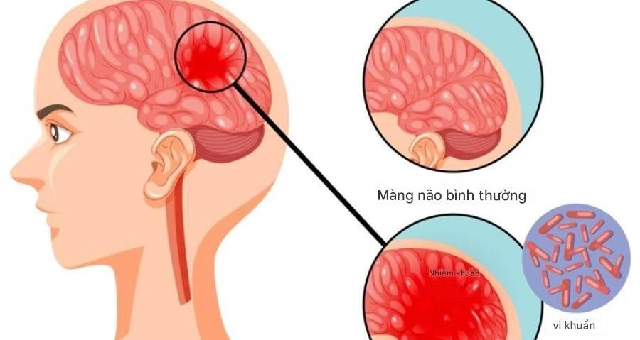 Viêm não mô cầu là bệnh nhiễm khuẩn cấp tính, có nguy cơ gây tử vong 