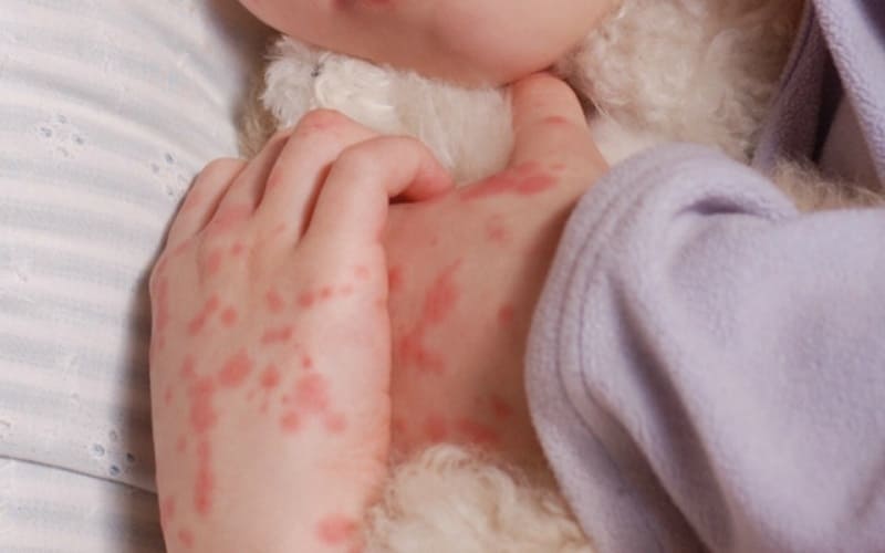Nhiều người bệnh não mô cầu gặp tình trạng xuất huyết dưới da